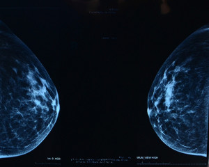mammogram